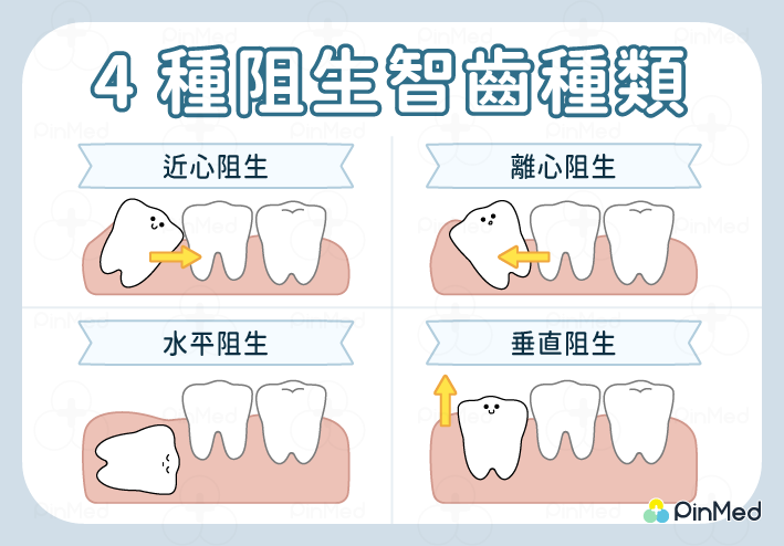 拔智齒＿阻生智齒種類