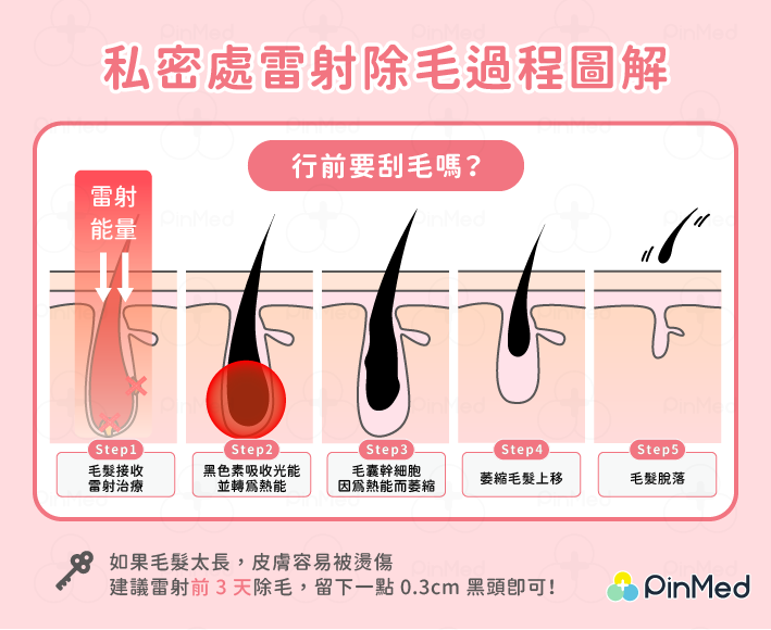私密處雷射除毛過程