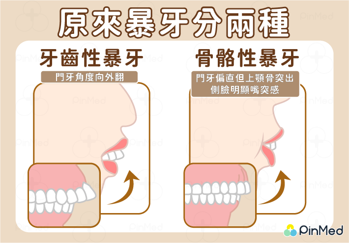 骨骼性暴牙、齒性暴牙