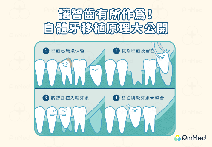 植牙價格_自體植牙原理