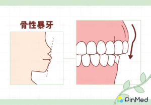 正顎手術_骨性暴牙