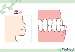 正顎手術_戽斗