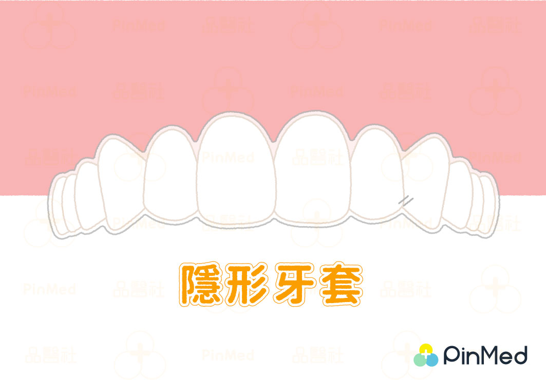 隱形牙套隱適美等隱形牙套是利用多副透明牙套的長時間配戴，讓牙齒移動位置。