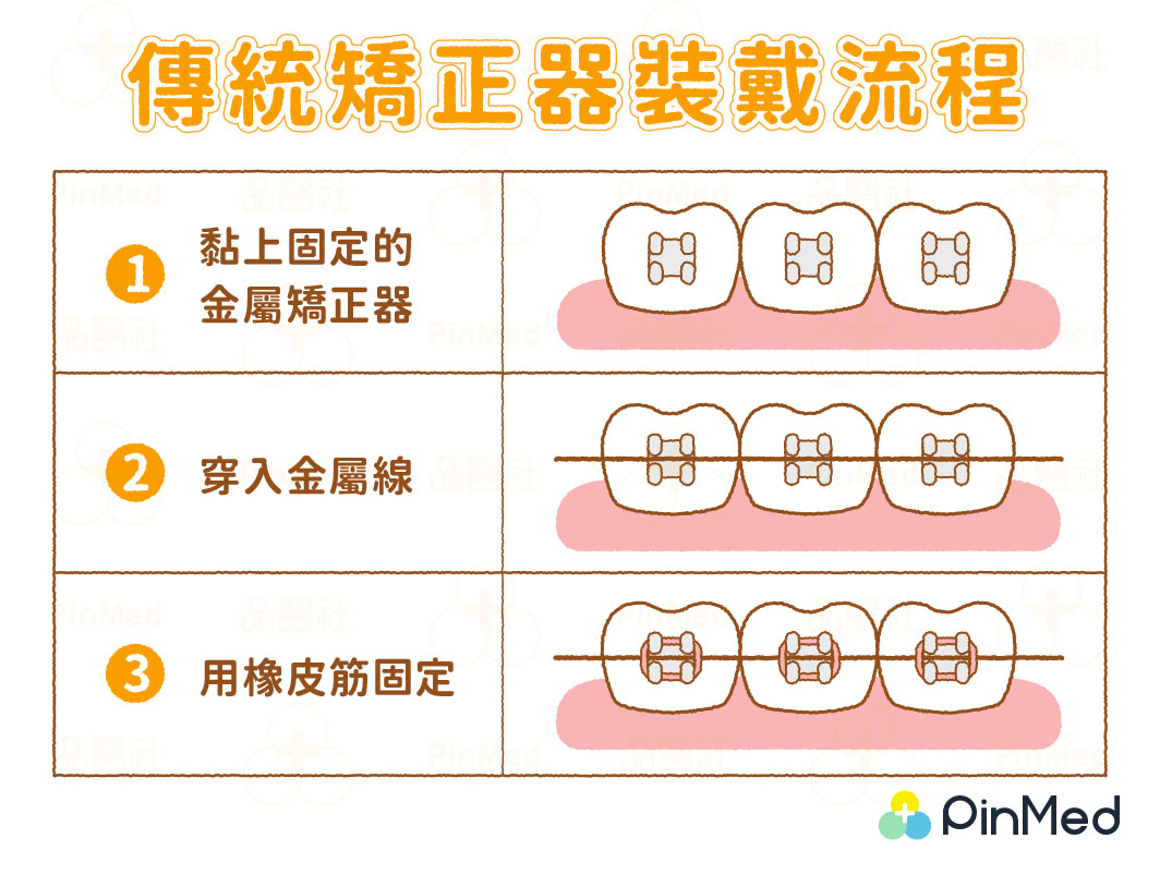 傳統矯正器會透過橡皮筋固定金屬矯正線。