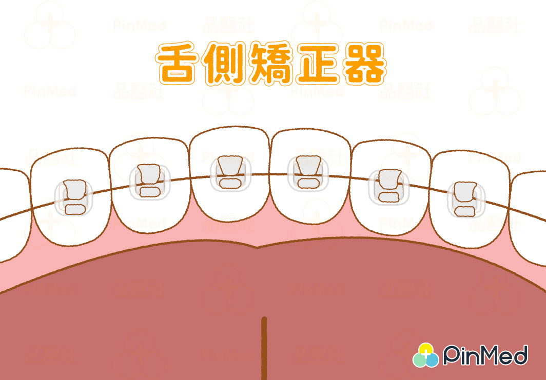 舌側矯正器：安裝在牙齒的背面，好處是不會被看到，雖然隱形牙套也美觀，但隱適美吃飯時要拿下比較麻煩，加上比起傳統牙套，