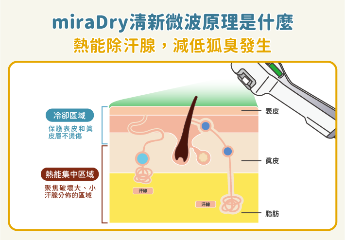 miraDry清新微波原理