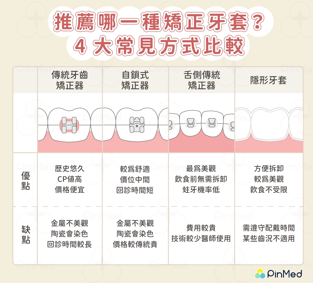 推薦哪一種矯正牙套？4大常見方式比較