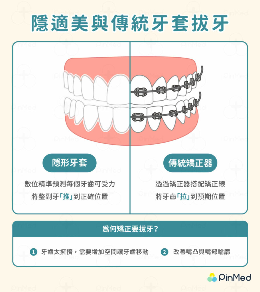 隱適美拔牙