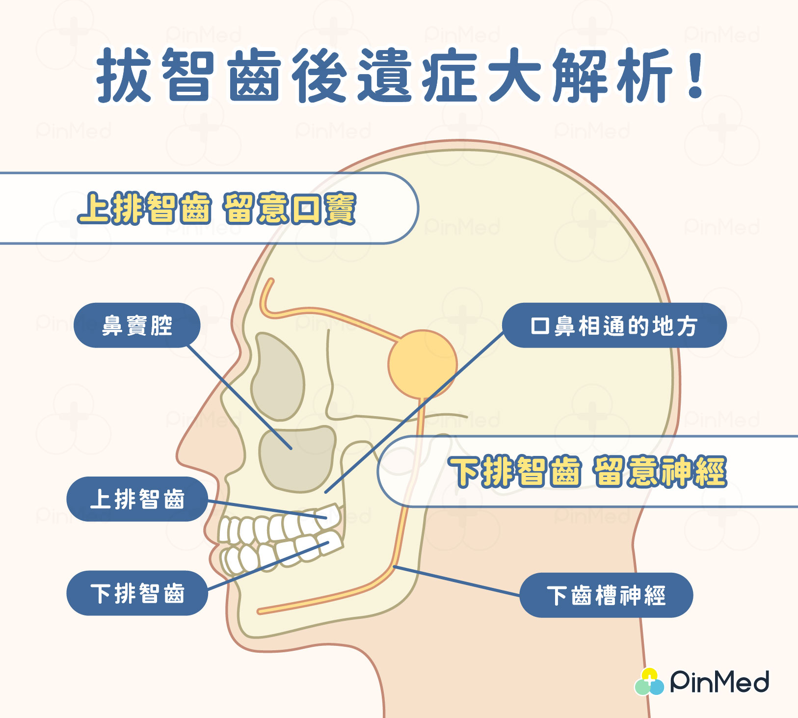 拔智齒後遺症大解析：上排智齒留意口竇、下排智齒留意神經
