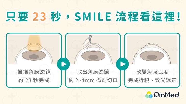 Smile全飛秒近視雷射流程