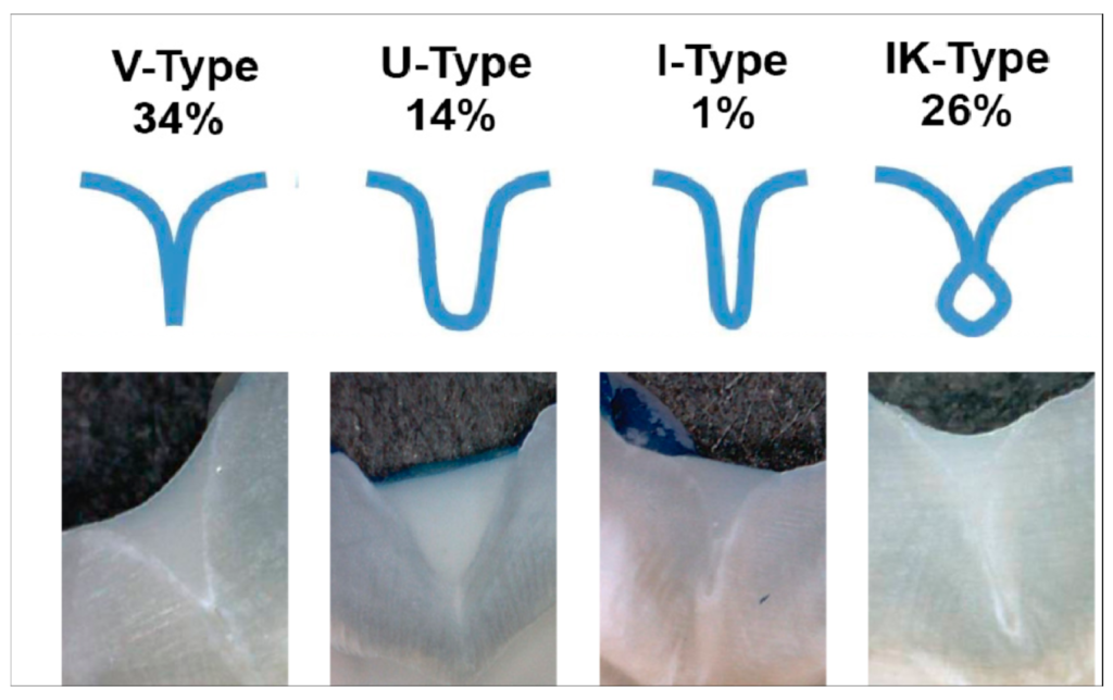 需要窩溝封填的臼齒種類比較：V型、U型、I型、IK型