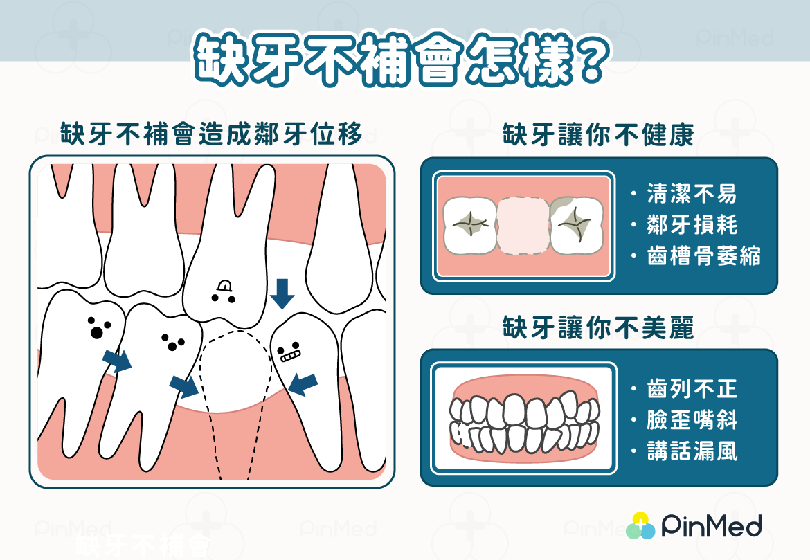 缺牙不補的風險