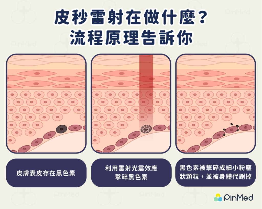 皮秒雷射在做什麼?流程原理告訴你