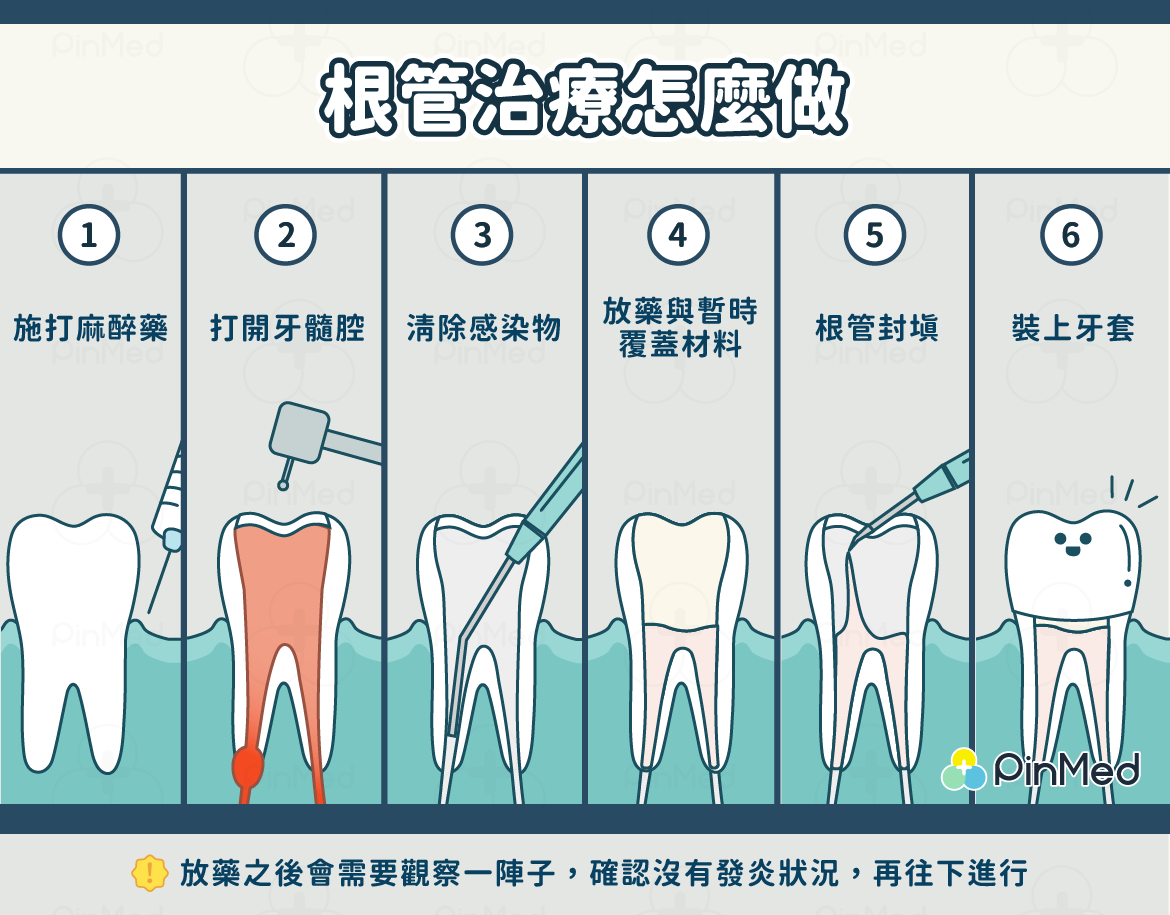 根管治療怎麼做