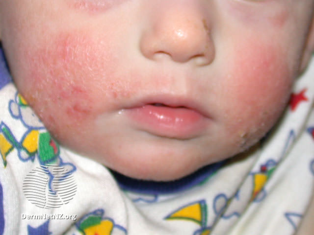 皮膚發紅、結痂。圖片來源：DermNet NZ, Atopic Dermatitis, CC BY-NC-ND 3.0 NZ