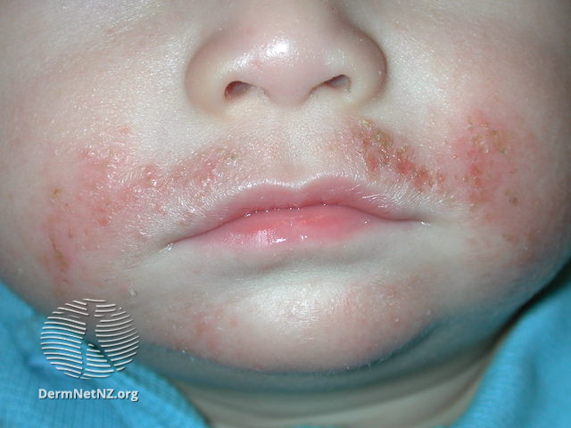 可以看到金黃色的淺痂，為葡萄球菌感染。圖片來源：DermNet NZ, Atopic Dermatitis, CC BY-NC-ND 3.0 NZ