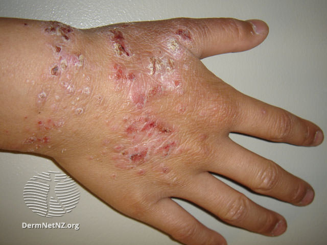 皮膚發紅、結痂。圖片來源：DermNet NZ, Atopic Dermatitis, CC BY-NC-ND 3.0 NZ