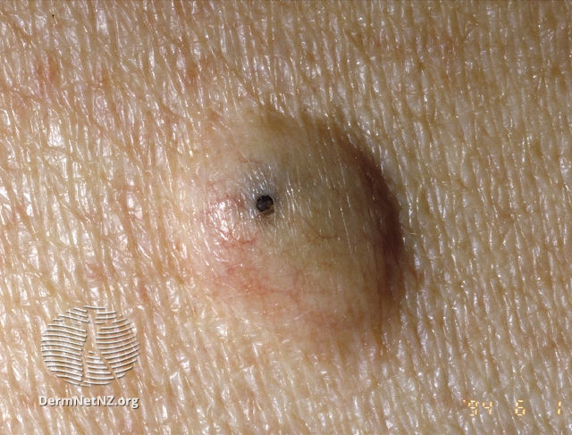 圖片來源：DermNet NZ, Epidermoid cyst, CC BY-NC-ND 3.0 NZ