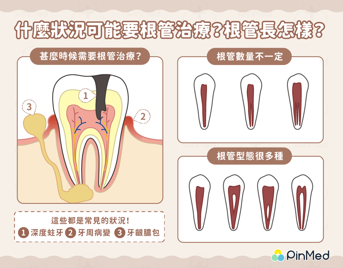 什麼狀況要根管治療