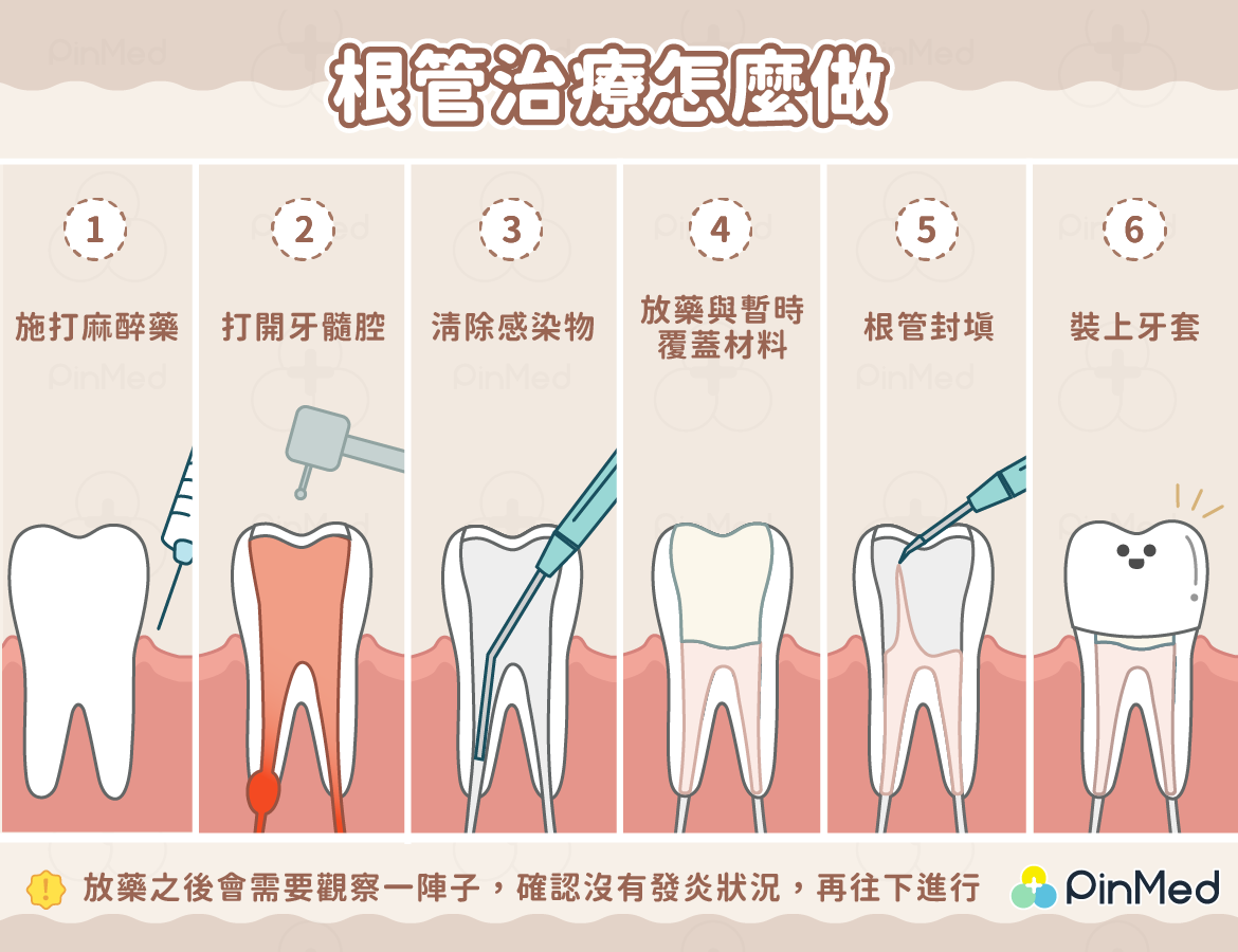 根管治療怎麼做