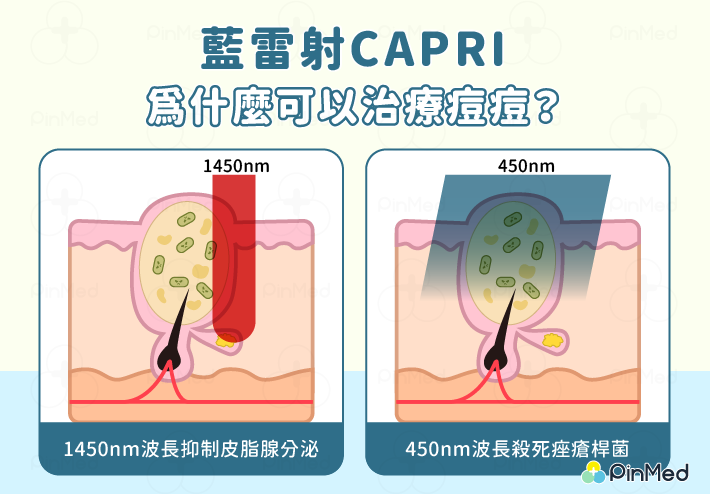 藍雷射CAPRI為甚麼可以治療痘痘?