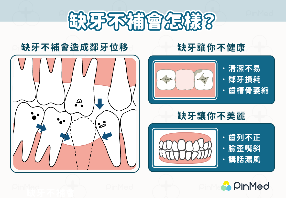 缺牙不補會怎樣