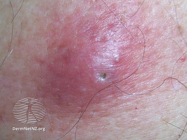 粉瘤。圖片來源：DermNet NZ, Epidermoid cyst, CC BY-NC-ND 3.0 NZ