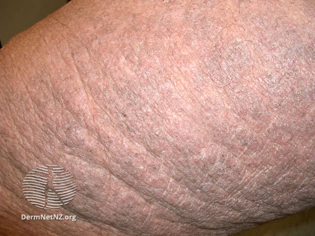 苔蘚化的皮膚。圖片來源：DermNet NZ, Atopic Dermatitis, CC BY-NC-ND 3.0 NZ
