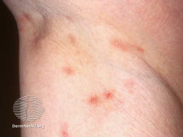 疥蟲感染。圖片來源：DermNet NZ, Scabies, CC BY-NC-ND 3.0 NZ