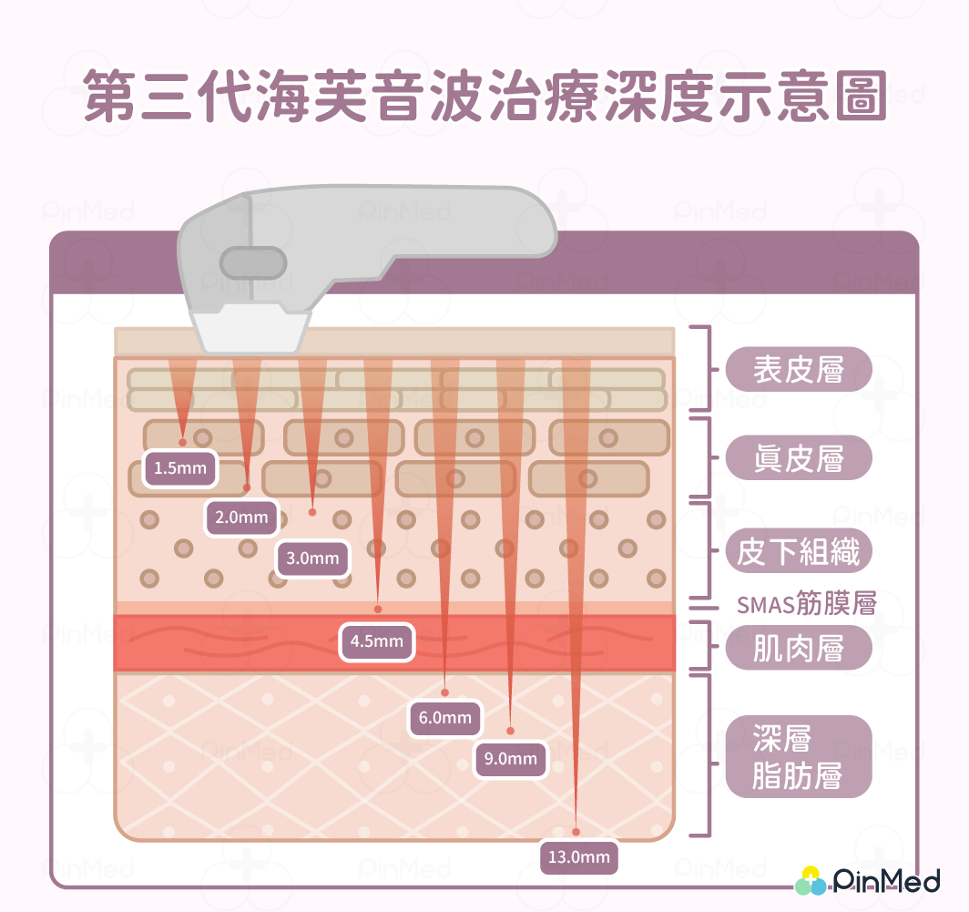 第三代海芙音波治療深度示意圖