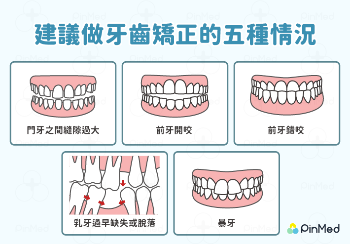 五種需要做兒童牙齒矯正的情況