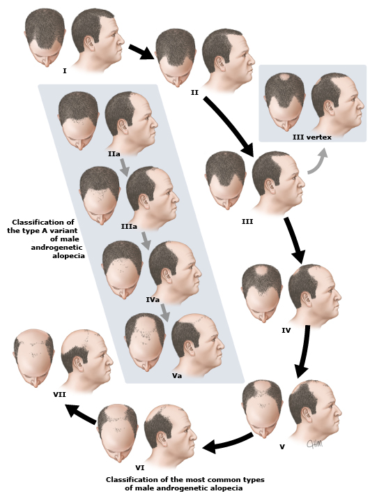 雄性禿共分為7級，其中又有不同的亞型。大家關注羅馬數字I～VII的分型即可。