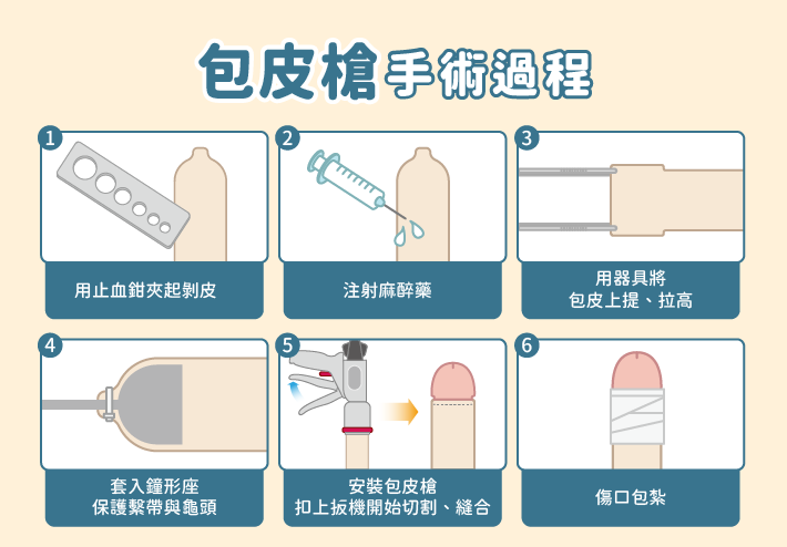 包皮槍手術流程