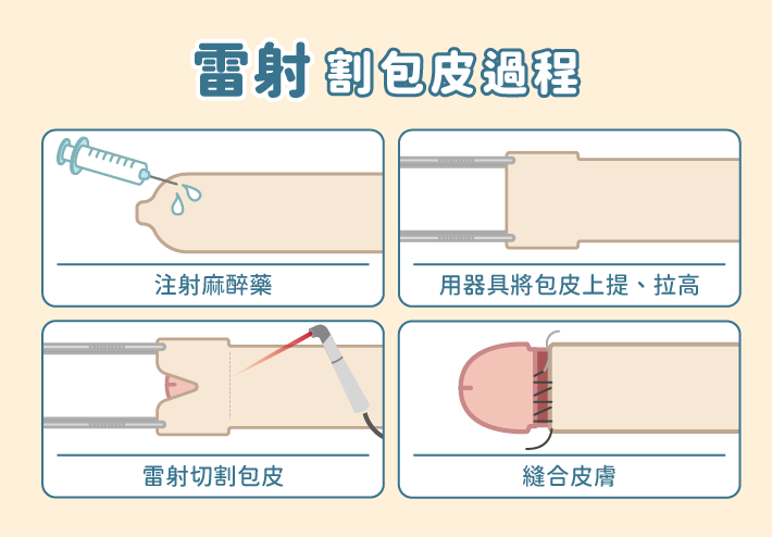 雷射割包皮手術步驟