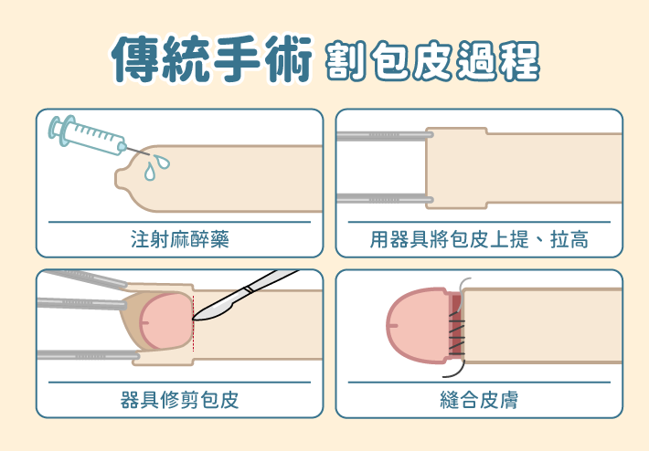 傳統手術割包皮步驟