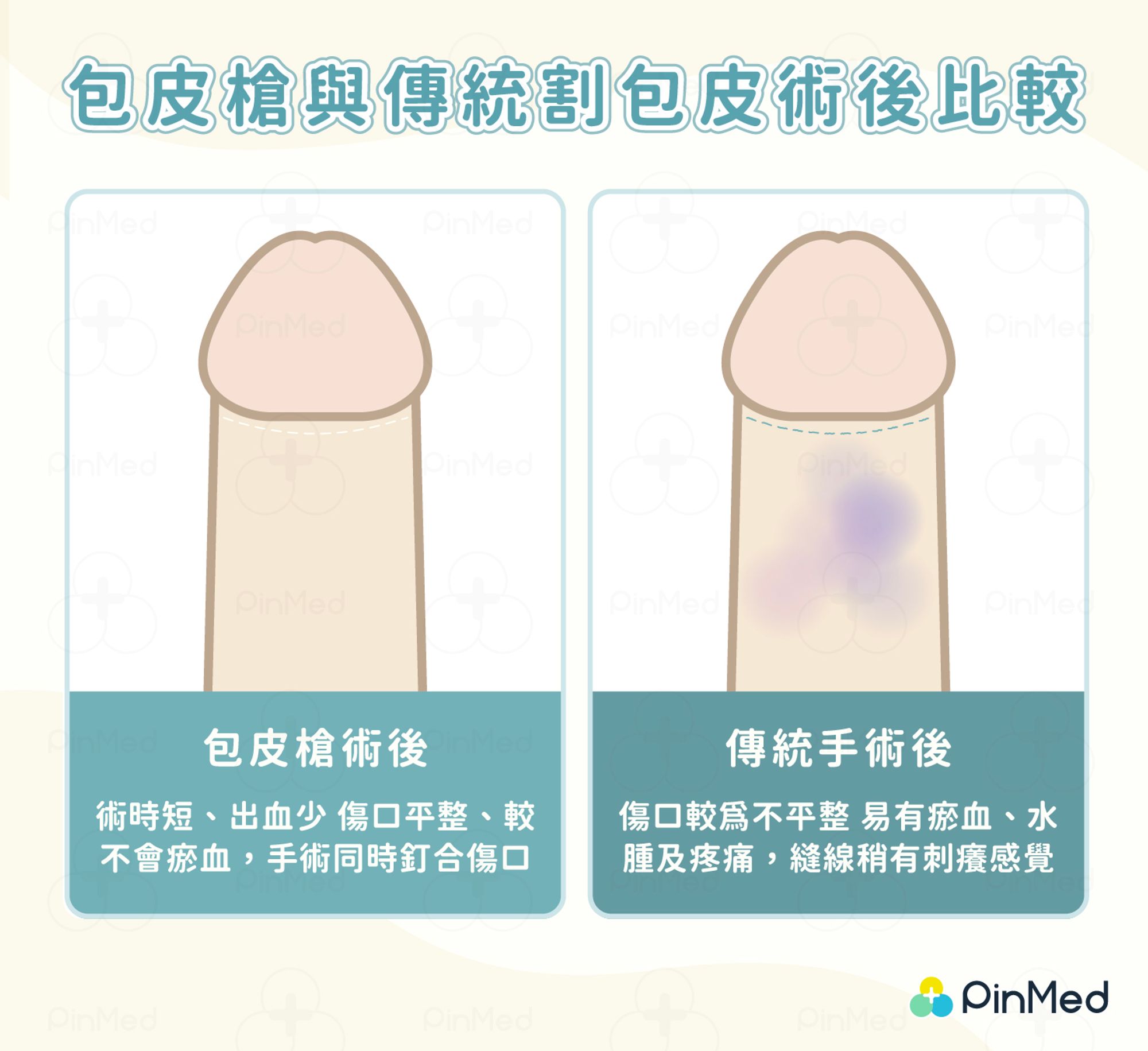 包皮槍與傳統割包皮術後比較