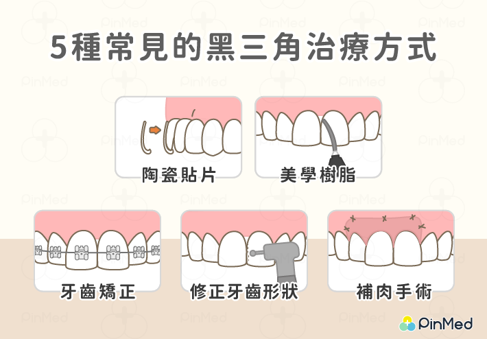 常見黑三角的治療方式：陶瓷貼片、美學樹脂、牙齒矯正、修整牙齒臨街面形狀、補肉手術。