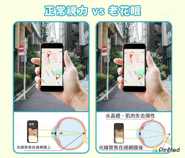 正常視力和老花眼的區別。老花眼看近處 ( 手機 ) 時比較模糊。