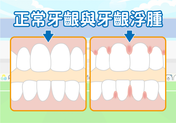 牙齦腫痛_牙齦浮腫