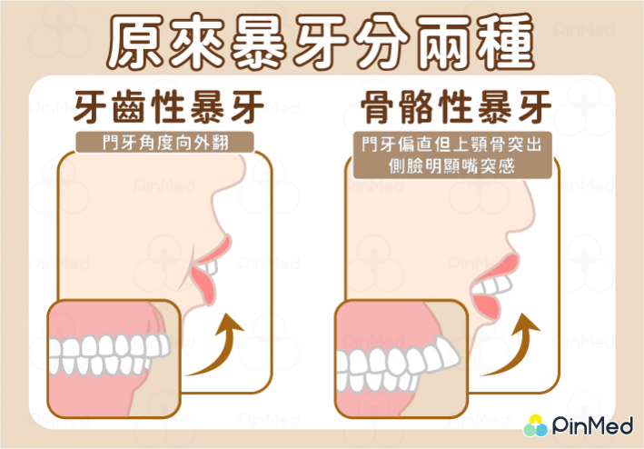 0323_牙科_暴牙_大圖 0323_牙科_暴牙_大圖