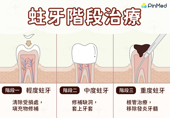 蛀牙_圖4