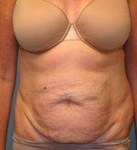 Body Contouring  Case 101 - Tummy Tuck