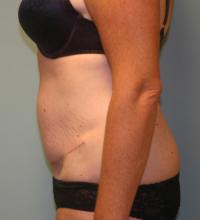 Body Contouring  Case 101 - Tummy Tuck