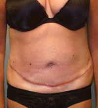 Body Contouring  Case 101 - Tummy Tuck