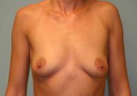 Breast Surgery  Case 102 - Breast Augmentation