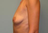 Breast Surgery  Case 102 - Breast Augmentation