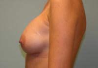 Breast Surgery  Case 102 - Breast Augmentation