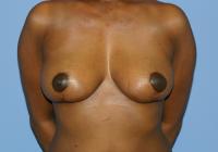 Breast Surgery  Case 104 - Breast Reduction