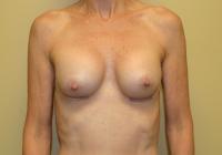 Breast Surgery  Case 105 - Breast Augmentation