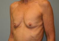 Breast Surgery  Case 105 - Breast Augmentation